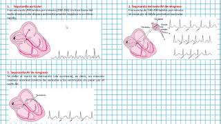 Taquicardia paroxística SUPRAVENTRICULAR Clases EKG 40 [upl. by Luane]