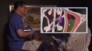 Balloon Sinuplasty  Surgeon narrates his inoffice procedure [upl. by Gualterio251]