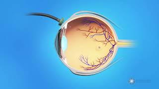 Vitrectomy Surgery for Macular Holes [upl. by Burget]