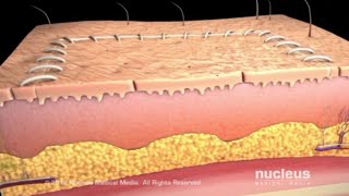 SKIN GRAFTING PLASTIC AND RECONSTRUCTIVE SURGERY [upl. by Charlena]