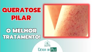 Qual MELHOR CREME Contra QUERATOSE PILAR  SAIBA NESSE VÍDEO [upl. by Dalia787]