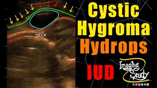 Cystic Hygroma  Hydrops Fetalis  Ultrasound  Anomaly  Case 214 [upl. by Weisburgh]