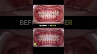 Under bite braces evolution braces orthodontist dentist dentisty cosmeticdentistry [upl. by Clapper559]