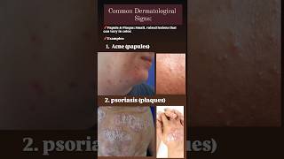 Dermatological signs papules acne acnetreatment psoriasis plaques [upl. by Charron]