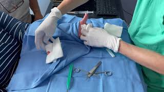 Foreign Body Removal Left Hand Foreign Object Excision [upl. by Mclyman811]