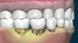 Tartaro e formazione di tasca subgengivalewmv [upl. by Templeton]