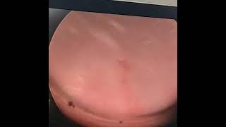 cystoscopy of common cloaca of 7 years female child with covering colostomy [upl. by Elamrej]