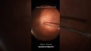 Vitrectomy for a Retinal Detachment Recorded with MicroREC  Dr João Duprat [upl. by Atena130]