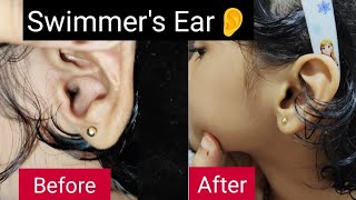 What is Swimmers Ear Ear Pain Treating Swimmers Ear  Treating Swimmers Ear rid of swimmer’s ear [upl. by Yral142]