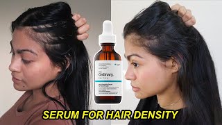 I tried The Ordinary Serum for Hair Density for 4 months amp THIS HAPPENED  Before and after results [upl. by Irodim]