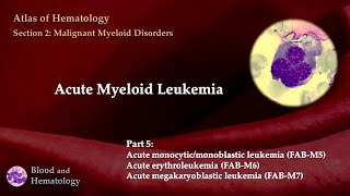 Acute Myeloid Leukemia AML  Part 5 [upl. by Ahsiuqram668]