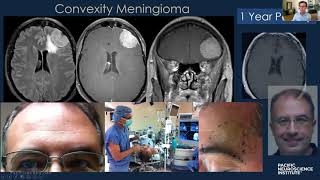 Keyhole Meningioma Removal with Dr Daniel Kelly [upl. by Yoshi378]