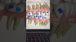 TIP 79  CANTEO OCLUSAL SIN MICROTORNILLOS [upl. by Anerda266]