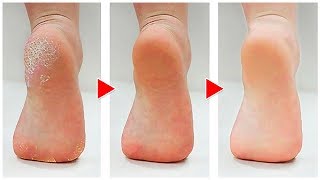 How to Get Rid of Calluses on Feet Naturally [upl. by Ottillia622]