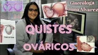 QUISTES OVARICOS POR GINECOLOGA DIANA ALVAREZ [upl. by Semajwerdna]