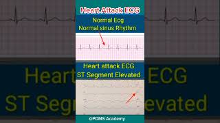 ECG changes During Heart Attack medicine ecg [upl. by Dorotea668]