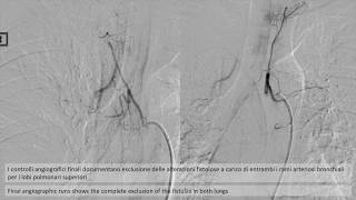 Percutaneous endovascular embolization of bronchial arteries [upl. by Nies]