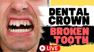 Tooth Crown Procedure  Front Tooth Crowns for Broken Teeth LIVE [upl. by Ymij]