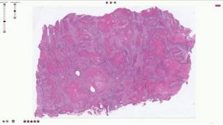 Histopathology  Squamous Cell Carcinoma of the Lung [upl. by Ycnahc88]