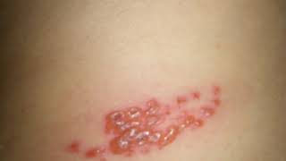 Difference Between Shingles and Herpes [upl. by Arlina340]