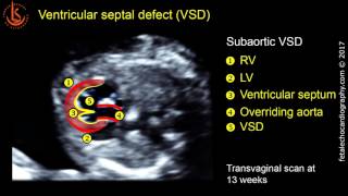 Fetal echocardiography at 1113 weeks Ventricular Septal Defect VSD [upl. by Koffler]