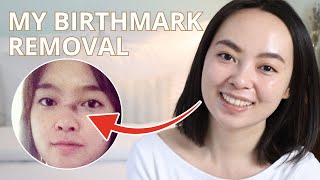 My Birthmark Nevus of Ota Removal – 6 Years Later [upl. by Nylemaj]