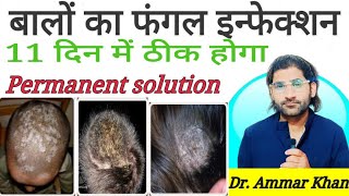 Hairs Balon ka fungal infection ab 11 din me hamesha ke liye thik hoga Hair fungal best cure [upl. by Netsreik]