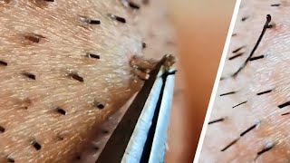 Ingrown hair removal compilation😌 [upl. by Ardnuassac]