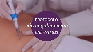 Protocolo Microagulhamento Estrias [upl. by Rivalee847]