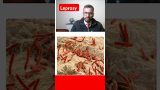 Leprosy nursingcompetition communicablediseases leprosy [upl. by Lennor]