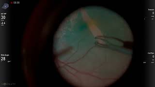 Peeling an epiretinal membrane along with reinforcing retinal tears using a scleral buckle [upl. by Leicester]