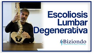 ▷ Escoliosis lumbar degenerativa ¿Qué es Síntomas y tratamiento [upl. by Anisah867]