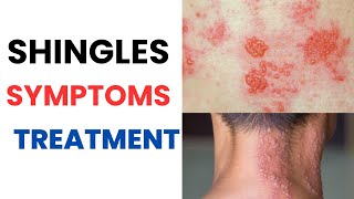 Herpes Zoster Shingles Symptoms Treatment Vaccine Contagious Rash Pain Relief Medication [upl. by Eromle]