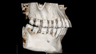 How to create a cephalometric radiograph from CBCT [upl. by Tahpos226]