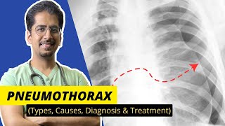 PNEUMOTHORAX Types Causes Diagnosis amp Treatment  Detailed video [upl. by Finzer]