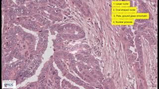 Papillary thyroid carcinoma microscopy  Talking slide [upl. by Yddor]