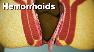 Hemorrhoidsdifferent types of hemorrhoids internal and external Hemorrhoids Hemorrhoids treatment [upl. by Buffy]