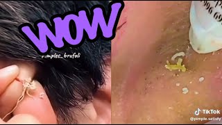 Top Satisfying Pimple Pops of 2024 Blackheads Cysts and More [upl. by Gotthelf]