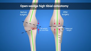 Overcorrected misalignment associated with poorer outcomes after openwedge high tibial osteotomy [upl. by Siana704]