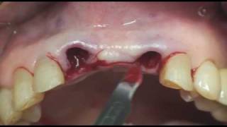 Dentium dental Implant Prosthetic112122 109 [upl. by Sacttler]