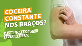 VOCÊ TEM COCEIRA PERSISTENTE NOS BRAÇOS E ANTEBRAÇOS  Aprenda como se livrar dessa coceira [upl. by Yma879]