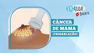 TRATAMENTO DO CÂNCER DE MAMA CIRURGIA VS CRIOABLAÇAO Shorts [upl. by Lyrak]