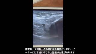 Handheld ultrasound devices for hemarthrosis  Japanese Subtitled [upl. by Zelten310]