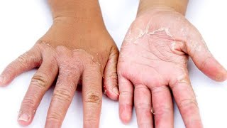 How I Use Lactic Acid 80 To Peel My Dry Hands Remove Dry Skin And Get Rid Of Hyperpigmentation [upl. by Duggan]