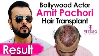 Celebrity Amit Pachori Hair Transplant in India  Advance Procedure amp Results  Medispa Jaipur India [upl. by Funk]