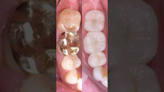 Here’s a behindthescenes look from a fullmouth reconstruction with a biomimetic approach dentist [upl. by Anerol]