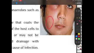 Odontogenic infections4th stage oral surgery part2 [upl. by Louanna50]