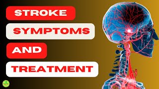 👉CAN WE PREVENT BRAIN HEMORRHAGE 【STROKE SYMPTOMS AND TREATMENT】 [upl. by Landon]