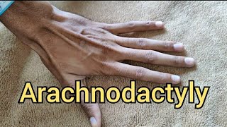 Arachnodactyly in Marfan Syndrome [upl. by Avihs]