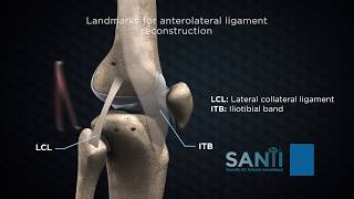 Anterolateral extraarticular procedures combined with ACL reconstruction [upl. by Nohsed]